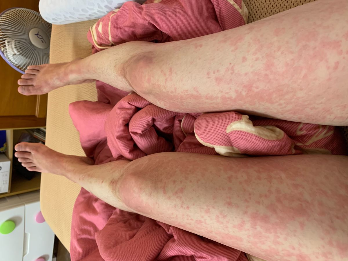 ▲長榮航空一名空服員疑罹患罕見免疫疾病「成人史迪爾氏症」病逝，亞大醫院過敏免疫風濕科醫師蔡肇基表示，史迪爾氏症屬全身性發炎免疫疾病，症狀包括反覆高燒、關節疼痛、皮疹與肝功能異常。（圖／醫院提供）