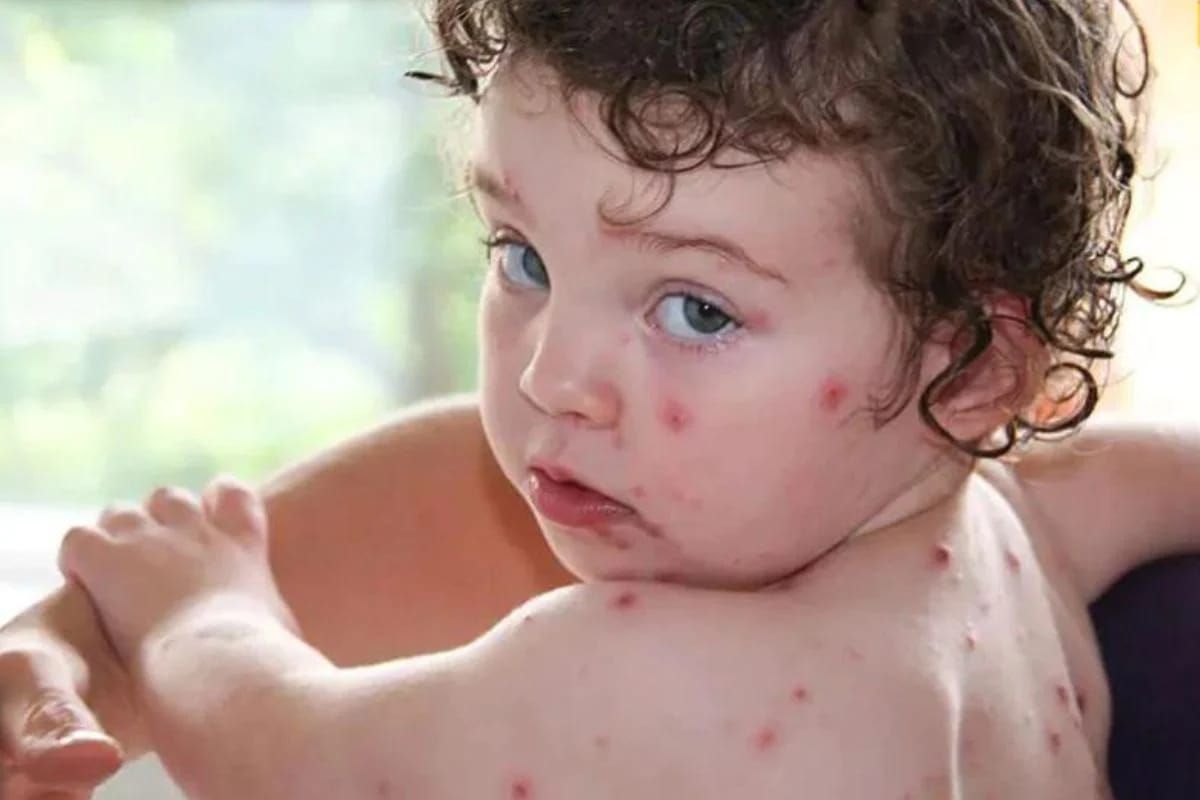 ▲印度爆發名為「番茄流感」（tomato flu）的神祕疾病。示意圖。（圖／翻攝自@newsfornikhil推特）