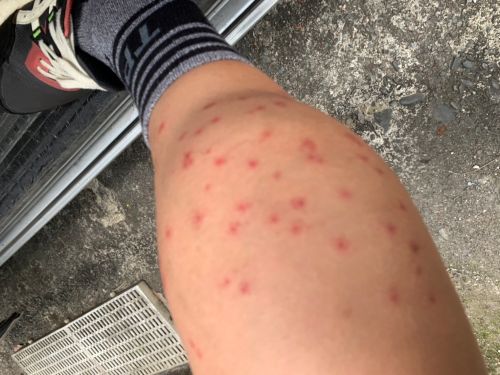 夏天防小黑蚊爆擊！吸血高峰時段曝　皮膚醫：5招避免「紅豆冰」
