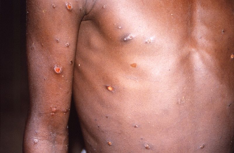 ▲全球多地陸續出現猴痘病例，不過世衛表示目前還不需要大規模接種。（圖／美聯社／達志影像）