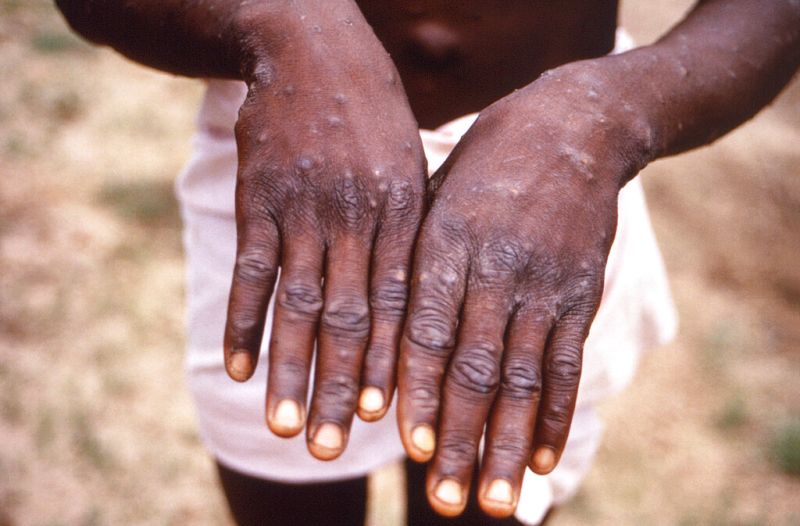 ▲根據世界衛生組織（WHO）資料，目前已接獲來自58個國家總計超過6000個猴痘（monkeypox）病例報告。（圖／美聯社）