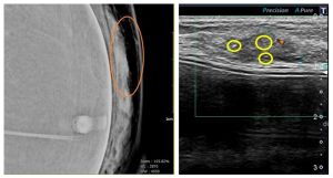 ▲A女乳房攝影後發現有微小鈣化（左圖橘色圈內）。B女超音波檢查，有亮亮的微小鈣化點，明顯是乳癌的特徵（右圖黃色圈內）。（圖／澄清醫院提供）