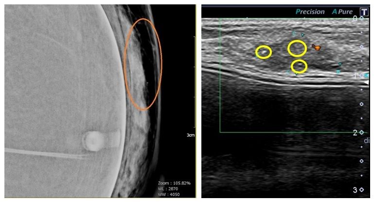 ▲A女乳房攝影後發現有微小鈣化（左圖橘色圈內）。B女超音波檢查，有亮亮的微小鈣化點，明顯是乳癌的特徵（右圖黃色圈內）。（圖／澄清醫院提供）