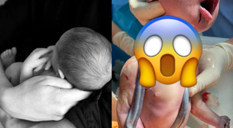 ▲寶寶出生「臍帶繞頸」是常見的狀況，但近日禾馨婦產科醫師林思宏9日晚間在臉書分享一位「真正的天選之人」照片，引起熱議。（圖/pixels、林思宏臉書）