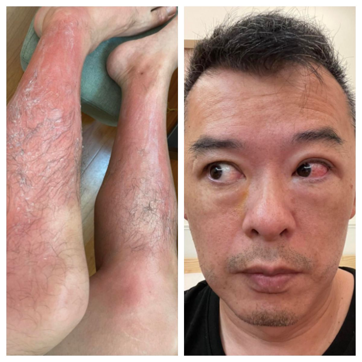 ▲網紅「Andy老爹」今（13）日下午突然PO出「雙腿燙傷、眼角膜受傷」的照片，兇手竟是「紫外線殺菌燈」。（圖／翻攝Andy老爹臉書）