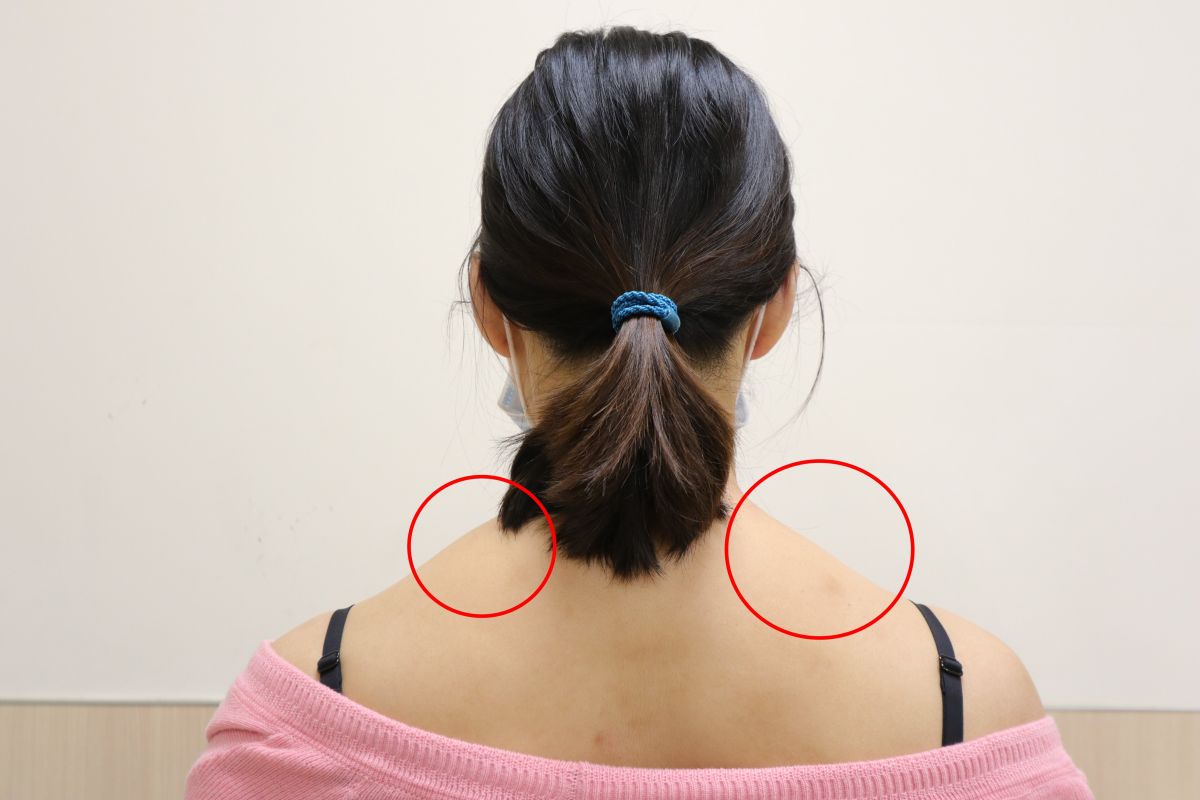 ▲肩膀兩側的「上斜方肌」太過發達，造成肩膀兩側腫得像小山丘一樣。(圖／醫院提供2022.6.16)