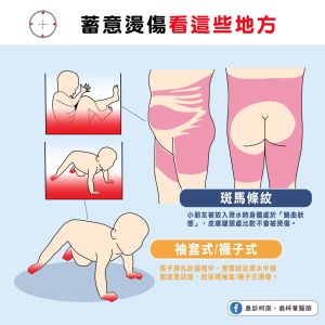 ▲若燙傷兒童身上的疤痕屬斑馬條紋，這即是家暴警訊。（圖／急診柯南．翁梓華醫師授權提供）