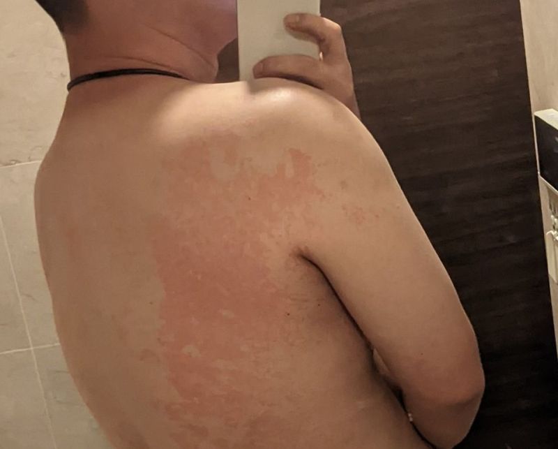 ▲前基進黨立委陳柏惟在臉書秀出5病纏身的裸背照,3Q粉好心疼。(圖/陳柏惟臉書,2022.06.20)