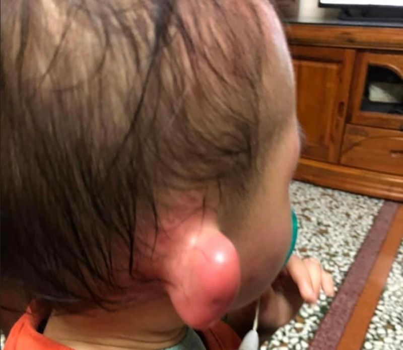 孩子耳朵被蚊蟲咬變「史瑞克」！醫曝原因：2招快速消腫