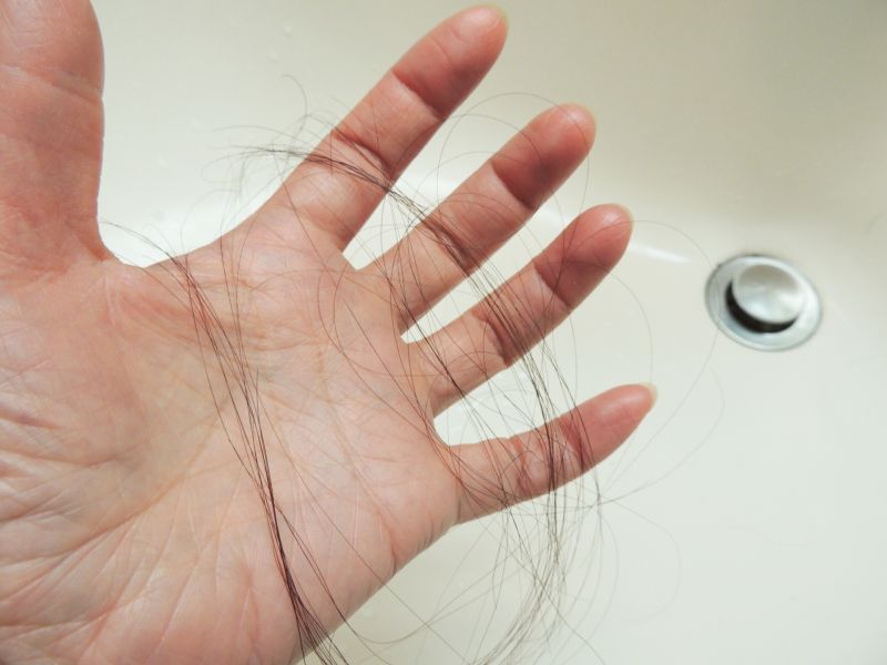▲不管是男女都有可能會面臨「雄性禿」的問題，皮膚科醫師周宛儀表示落髮困擾男女都會有，如果真的感到困擾就應該就醫，減緩掉髮速度。（示意圖／取自photo AC）