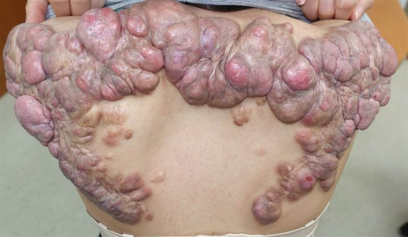 ▲27歲的陳小姐，10多歲時背部長出2顆小小的突起物，以為是青春痘，後來突起物蔓延導致背部隆起，就像一條「巨蟲」長在肩膀後面。（圖／基隆長庚醫院提供）