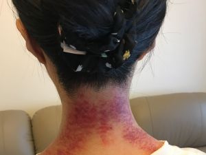 中暑分陰陽？上班族最常「中陰暑」　頭痛喝這個秒緩解
