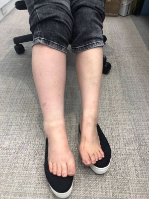 開刀清除髖關節血塊 盧秀燕手術後病容曝光 ▲盧秀燕小腿昨深夜再度腫脹,比第一次就醫時更嚴重。(圖/台中市政府提供,2022.07.27)