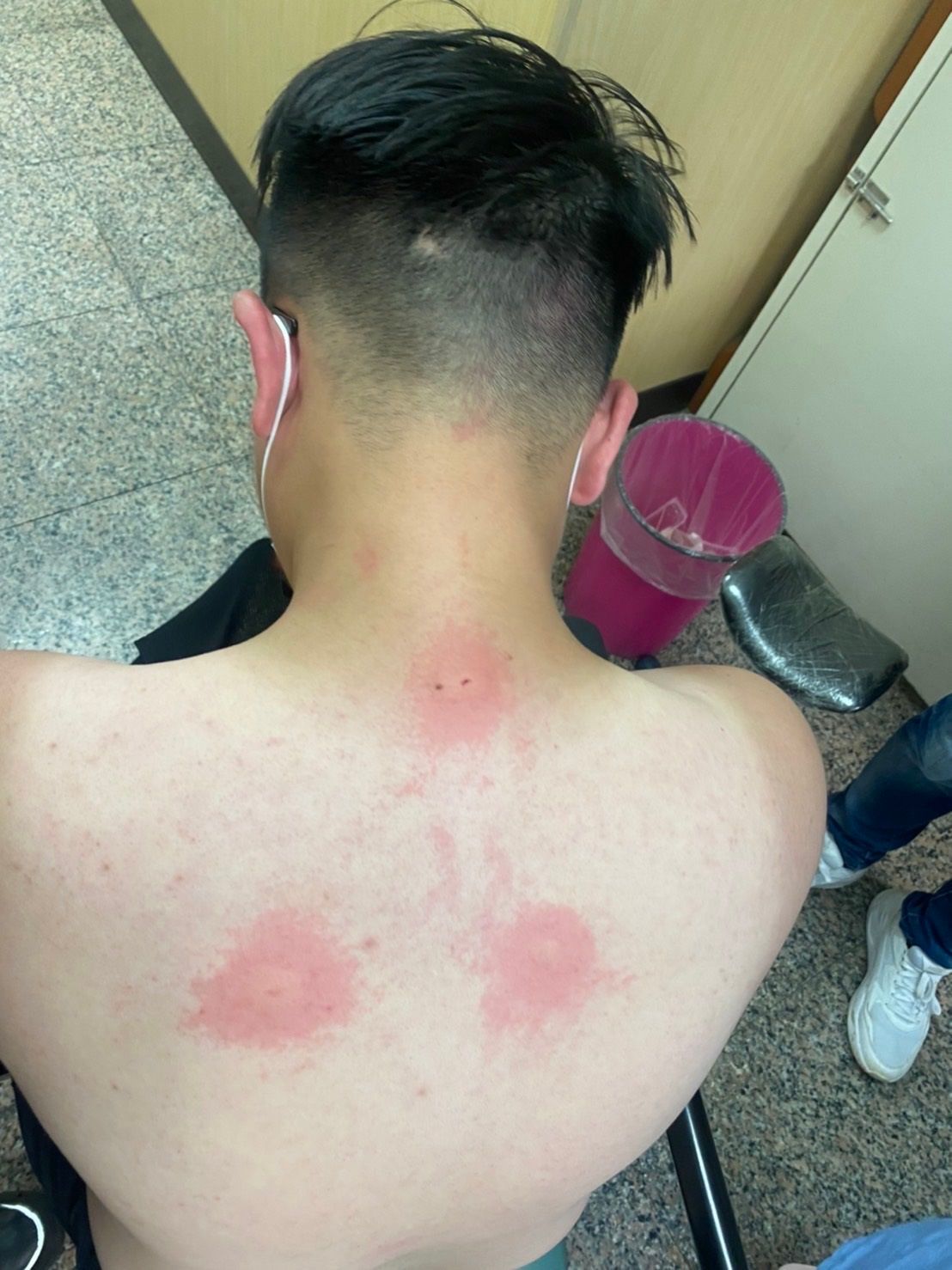 ▲搜山員警慘遭虎頭蜂攻擊，背部傷口紅腫（圖/記者鄧力軍翻攝）