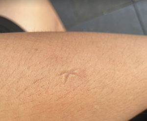 被蚊子叮「狂用指甲按X」恐更癢還留疤！醫曝3招有效止癢
