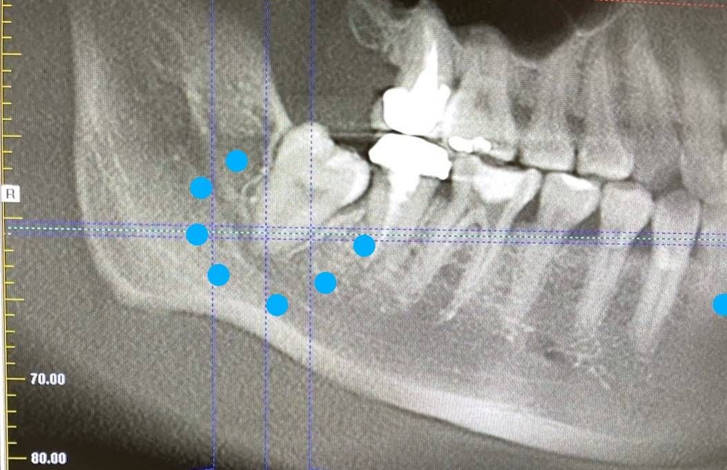 ▲王小姐長歪的智齒已經壓迫到右側下齒槽神經管，導致王小姐右下巴臉頰、嘴唇周圍的麻痺及疼痛感。（圖／聖保祿醫院提供）