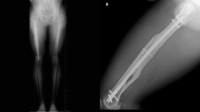 館長中槍2年了！X光照曝「子彈碎片殘留一堆」：腳天天痛