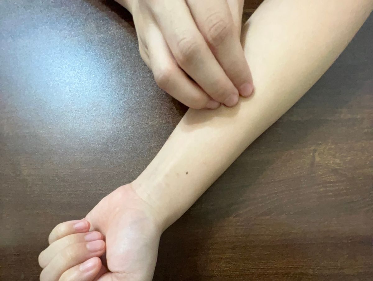 濕疹反覆發作抓到崩潰 醫：不只擦藥還有「標靶新解」