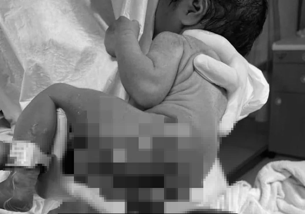 ▲一名媽媽表示，今年5月中她於三總內湖分院生下女兒後，怎料產後幾小時，醫師卻轉告小嬰兒洗澡時出現燒燙傷，全身有25%的二度燒燙傷，屁股大面積脫皮。（圖／翻攝自2022虎寶寶媽媽）