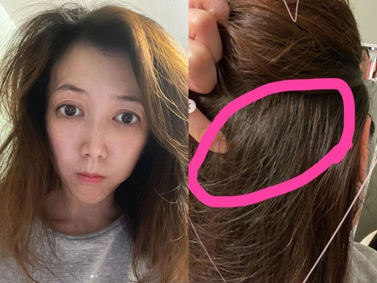 ▲廖家儀後腦勺浮腫起了一條筋。（圖／翻攝廖家儀IG）