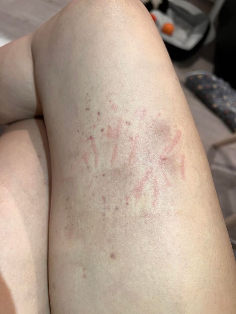 ▲唐玲曬出自己的大腿照片，都是手抓的血痕跡，讓大家看了很心疼。（圖／唐玲臉書）