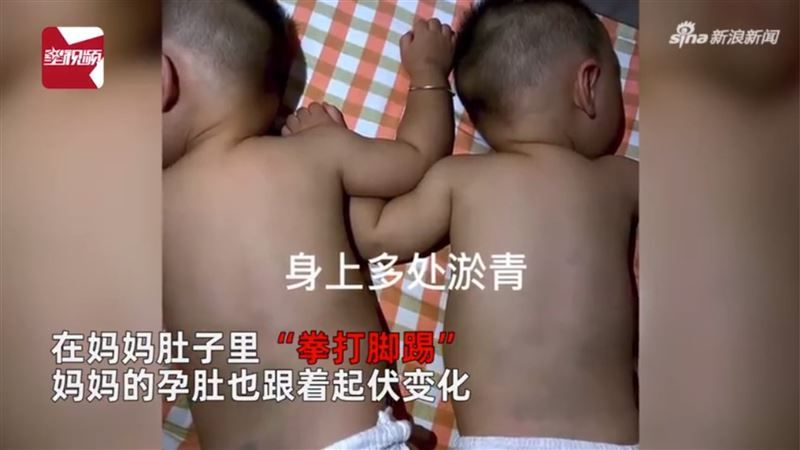 ▲中國一位母親近日上傳雙胞胎在肚裡打架出生後渾身瘀青影片，引發熱議。（圖／翻攝自微博）