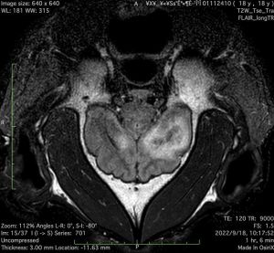 ▲MRI影像顯示，團團的左大腦半球有局部液化壞死病變，右大腦半球也可見到類似病變。（圖／台北市立動物園）