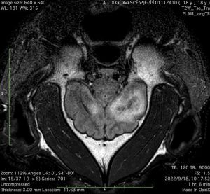 ▲MRI影像顯示,團團的左大腦半球有局部液化壞死病變,右大腦半球也可見到類似病變。(圖/台北市立動物園) ▲MRI影像顯示,團團的左大腦半球有局部液化壞死病變,右大腦半球也可見到類似病變。(圖/台北市立動物園)