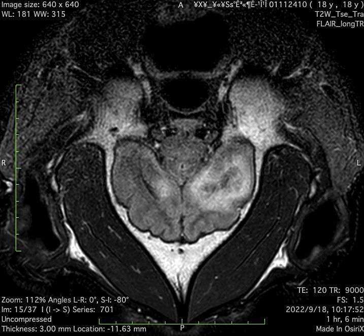 ▲MRI影像顯示，團團的左大腦半球有局部液化壞死病變，右大腦半球也可見到類似病變。（圖／台北市立動物園）