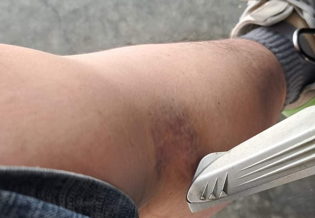 ▲有民眾曬出一張瘀青照，自己的小腿慘遭「脛骨殺手」弄傷，更釣出一票苦主齊喊痛。（圖／翻攝《爆廢公社公開版》）