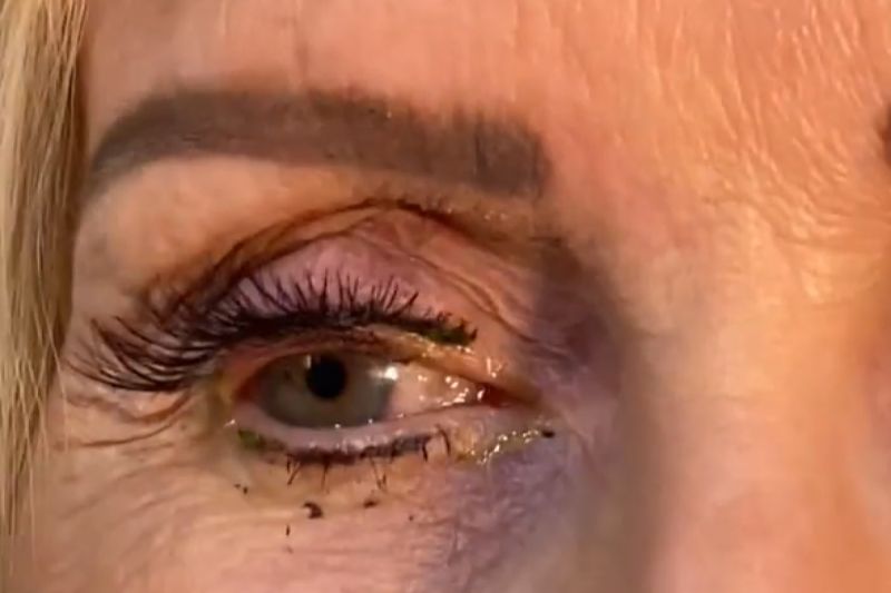 忘拔又再戴!女眼內藏23片隱形眼鏡 醫翻出「一片慘綠」