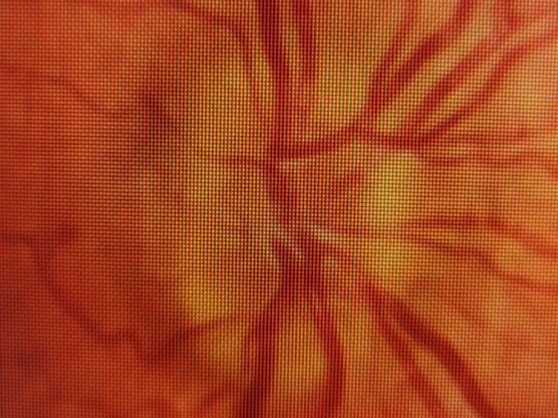 ▲病人雙眼的視神經盤出現早期的視乳頭水腫。（圖／達特楊眼科集團提供）