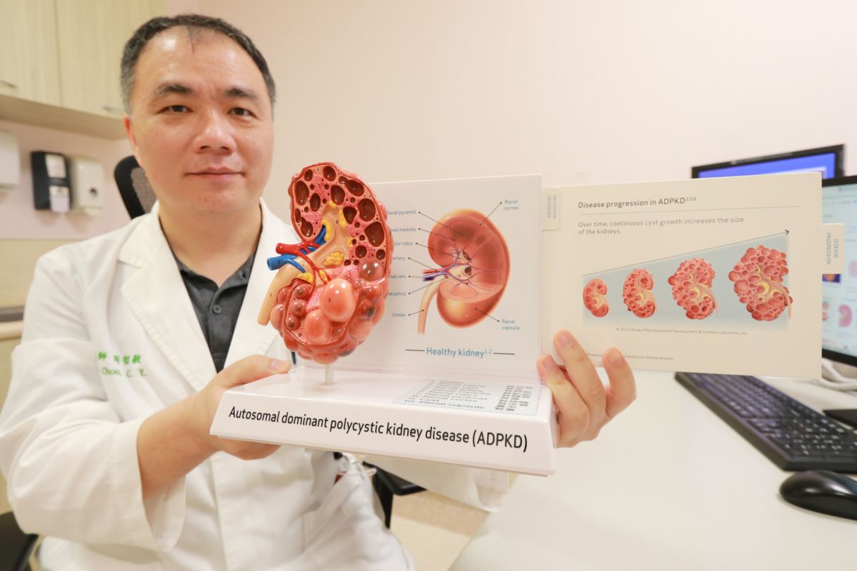 ▲醫師透過多囊腎模型，提醒民眾若有家族多囊腎病史，或者頻頻出現蛋白尿、腰痛、發燒等症狀，就要提高警覺。(圖／醫院提供2022.11.10)