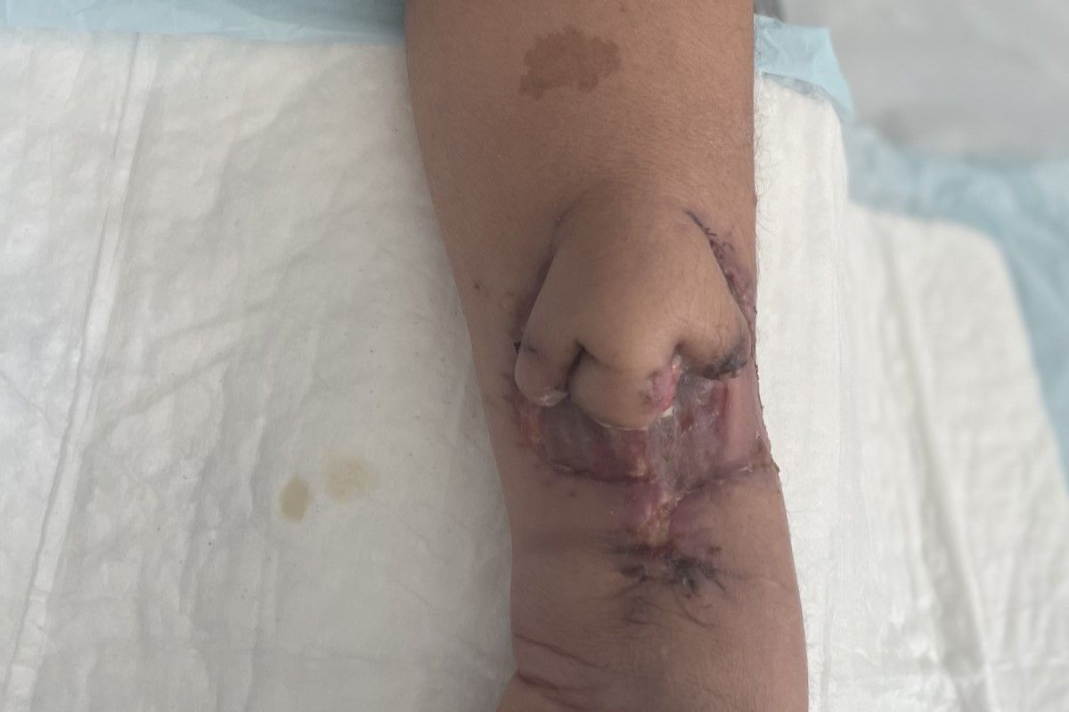 ▲罹癌女手臂上長出鼻子，醫師成功將其移植到她的面部，還能正常呼吸。（圖／CHU de Toulouse 臉書）