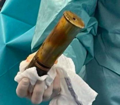 ▲法國一名高齡88歲的男子就醫時，被醫師發現直腸中竟塞入一顆長達20公分的「一戰時期的未爆彈」。（圖／翻攝Var-Matin推特）