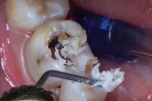 ▲牙醫用鑷子一點一點挖出食物殘渣。（圖／Instagram：thekidzdentist1）