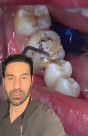 ▲美國牙醫分享一個可怕的蛀牙病例。（圖／Instagram：thekidzdentist1）