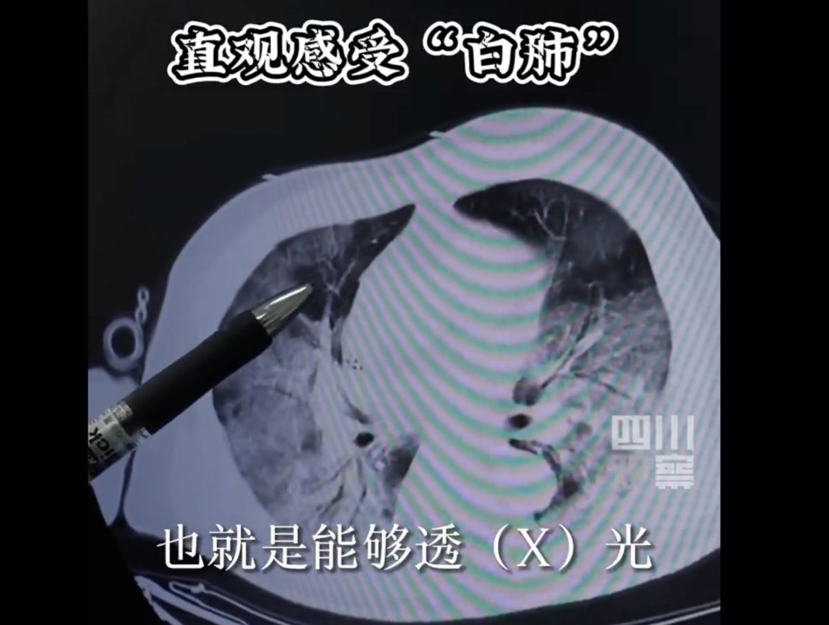 ▲中國境內疫情持續蔓延，傳出有許多人出現「白肺」的症狀，恐怖名稱讓許多民眾看了就害怕。（圖／翻攝自微博）