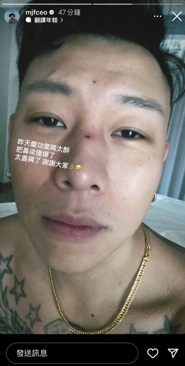 ▲瘦子慶功宴喝太醉，不慎撞傷鼻樑。（圖／翻攝自瘦子IG）