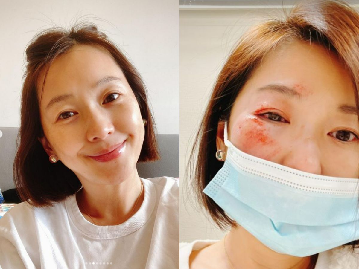 ▲六月露營跌倒整張臉破相。（圖／翻攝六月IG）