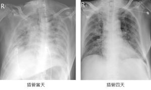 ▲蘇一峰近日分享，一名60歲染疫台商胸部X光片，出現肺炎重症插管治療，俗稱「大白肺」。（圖／翻攝蘇一峰臉書）
