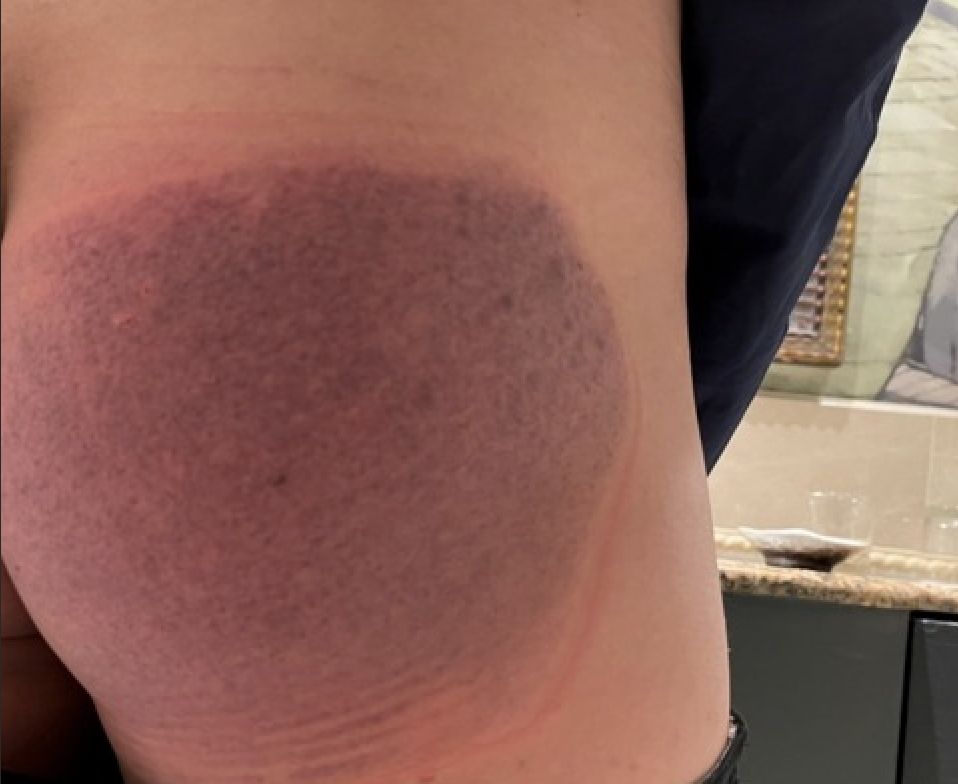 ▲投訴人表示，日前帶家人去花蓮遠雄悅來飯店渡假，沒想到泳池底部的排水孔破裂，差點將他吸入下水道，造成臀部嚴重瘀青受傷。（圖／當事人授權提供）