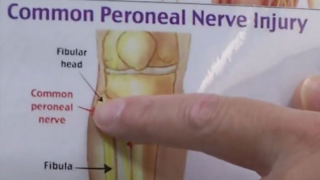 ▲七賢脊椎外科醫院微創脊椎外科蔡東翰副院長指出小腿腓神經之位置。（圖／七賢脊椎外科醫院提供）