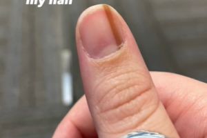 女指甲上長「淺棕色直線」！一查是罕見癌症　差點被截肢
