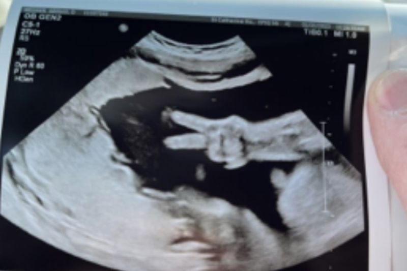 ▲美國孕婦正在做超音波時，肚中女兒突然比出YA手勢。（圖／Kyle Weener 臉書）