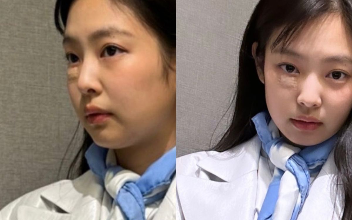 ▲BLACKPINK成員Jennie今赴巴黎參加香奈兒大秀，受傷右臉大方公開。（圖／Jennie IG）