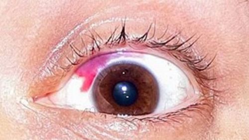 ▲ 「結膜下出血」白眼球出現整片的鮮紅血塊。（圖／記者陳美嘉翻攝）