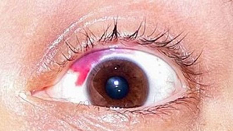 ▲ 「結膜下出血」造成白眼球出現整片血塊，但多數無其他症狀，也不會造成視力減退。（圖／記者陳美嘉翻攝）