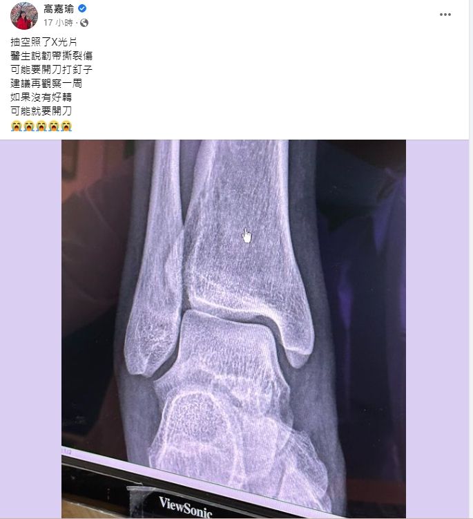 ▲高嘉瑜昨天在臉書PO出X光照。(圖/翻攝高嘉瑜臉書)