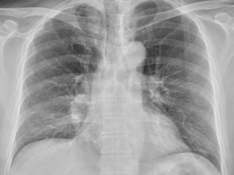 ▲一名40多歲男子咳嗽一個月都沒好，就醫照X光發現已肺癌末期。（圖／翻攝蘇一峰臉書）
